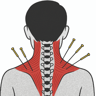 Akupunktur - Nacken